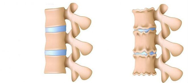 Co to jest osteochondroza