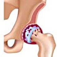 Artroza stawu biodrowego