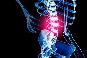 osteochondroza kręgosłupa lędźwiowego