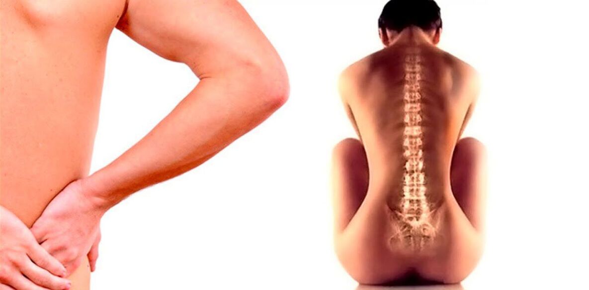 ból dolnej części pleców spowodowany osteochondrozą