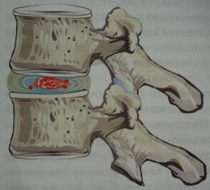 Pierwszy etap osteochondrozy